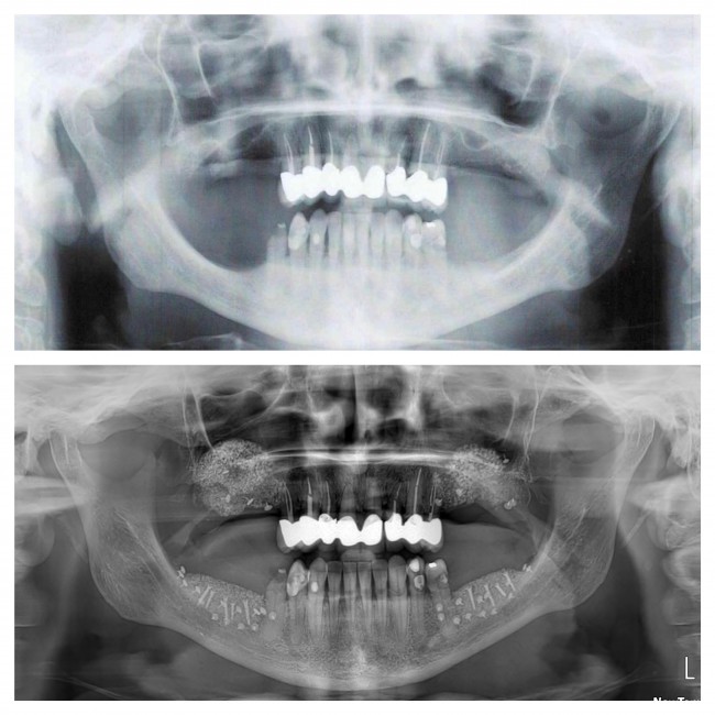 Zubní implantát nebolí a vrátí vám dokonalý úsměv
