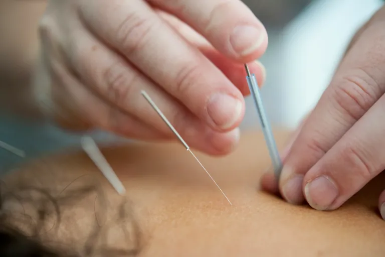Za jak dlouho zabere akupunktura a co vše dokáže vyléčit?